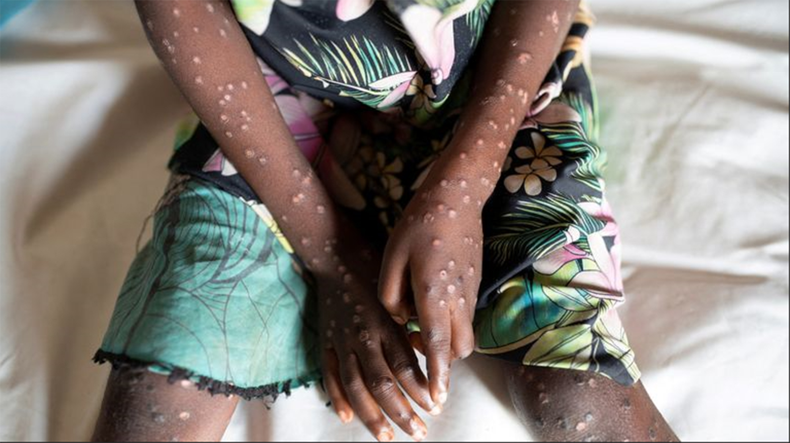 Africa put on high alert for Mpox; outbreak declared public health emergency